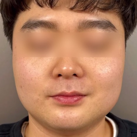 온다리프팅 심부볼제거 통증없이 가능합니다 관련 이미지 10