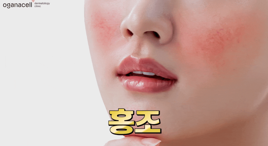 안면홍조 레이저 붉어진 얼굴 관리법 관련 이미지 3