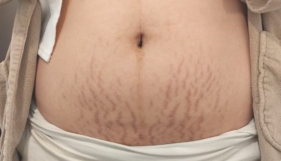 튼살 피부과에서 알려주는 붉은 튼살과 하얀 튼살 차이점 관련 이미지 2