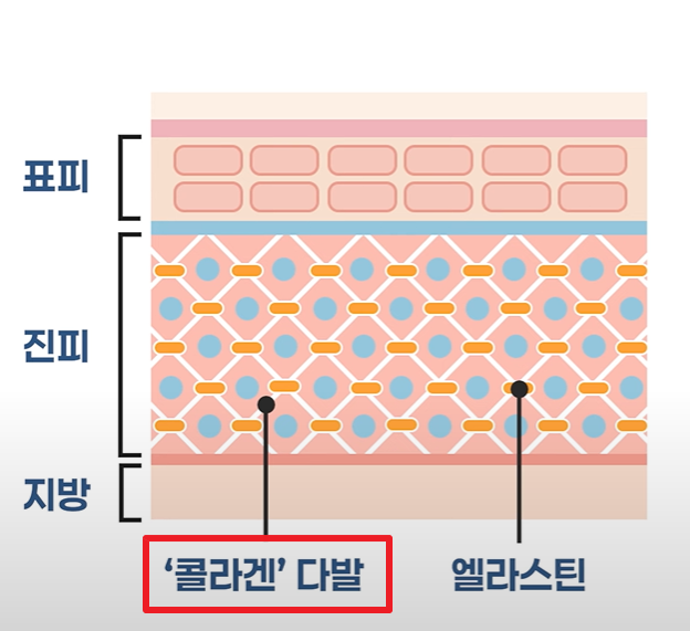 튼살 피부과에서 알려주는 붉은 튼살과 하얀 튼살 차이점 관련 이미지 4
