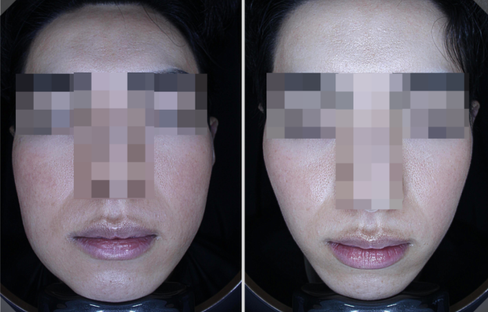 보톡스 내성 생기면 어쩌죠? 20년간 맞은 결과와 효과 관련 이미지 9
