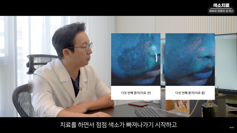 피부과 치료도 과유불급! 색소치료의 모든 것 #기미#색소병변#오타모반 | 오프라이드 오가나 관련 이미지 24