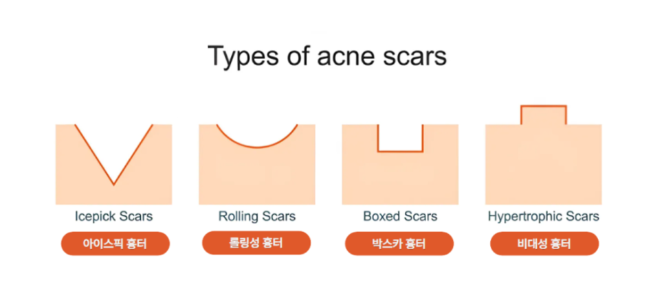 여드름 흉터 쥬베룩 어디까지 좋아질 수 있을까? 관련 이미지 5