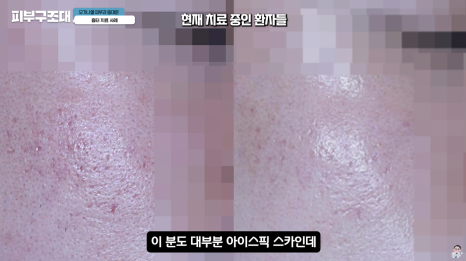 여드름 흉터 쥬베룩 어디까지 좋아질 수 있을까? 관련 이미지 14