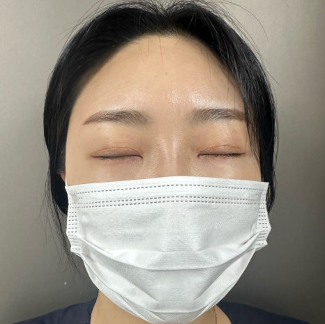 이마 필러 꼭 2가지는 체크해 보시길 당부드립니다. 관련 이미지 6