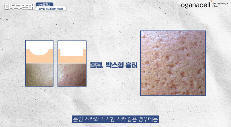 여드름 패인흉터 치료 방법 제대로알자 관련 이미지 14