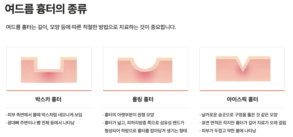 여드름 흉터, 염증 치료 가격만 비교해선 안되는 이유 관련 이미지 4