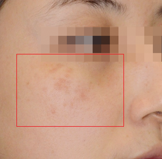 기미제거 레이저 의사가 사용하는 것 <공개> 관련 이미지 3