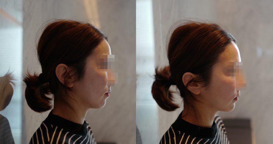 30대 여성 피부 개선 전략 - 울쎄라, 필러 시술 후기 관련 이미지 8