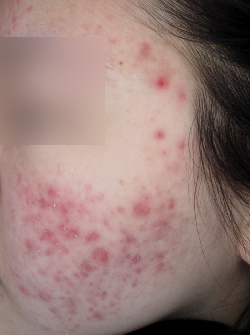 여드름 흉터, 염증 치료 가격만 비교해선 안되는 이유 관련 이미지 7