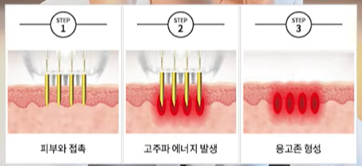 좁쌀 여드름 레이저 시술 전 필독! 이거 알고 받으세요! 관련 이미지 9