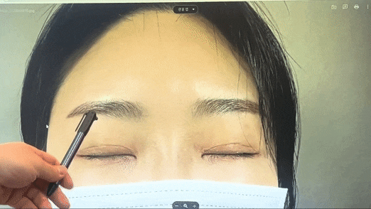 이마 필러 꼭 2가지는 체크해 보시길 당부드립니다. 관련 이미지 12