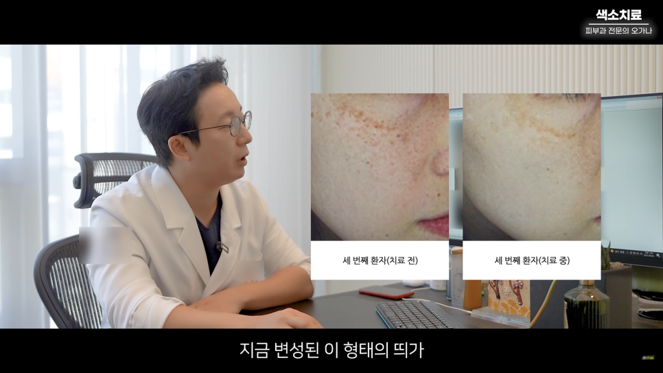 피부과 치료도 과유불급! 색소치료의 모든 것 #기미#색소병변#오타모반 | 오프라이드 오가나 관련 이미지 21
