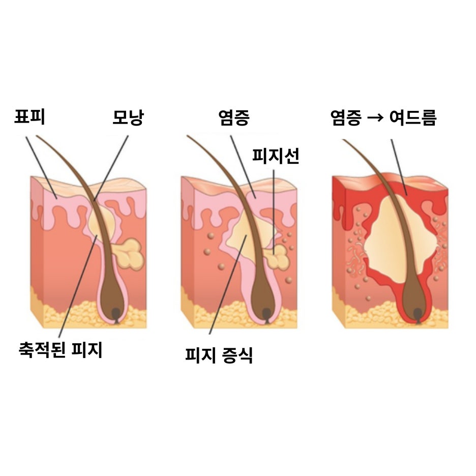 피부장벽 개선, 치료만큼 중요한건 00입니다 관련 이미지 6