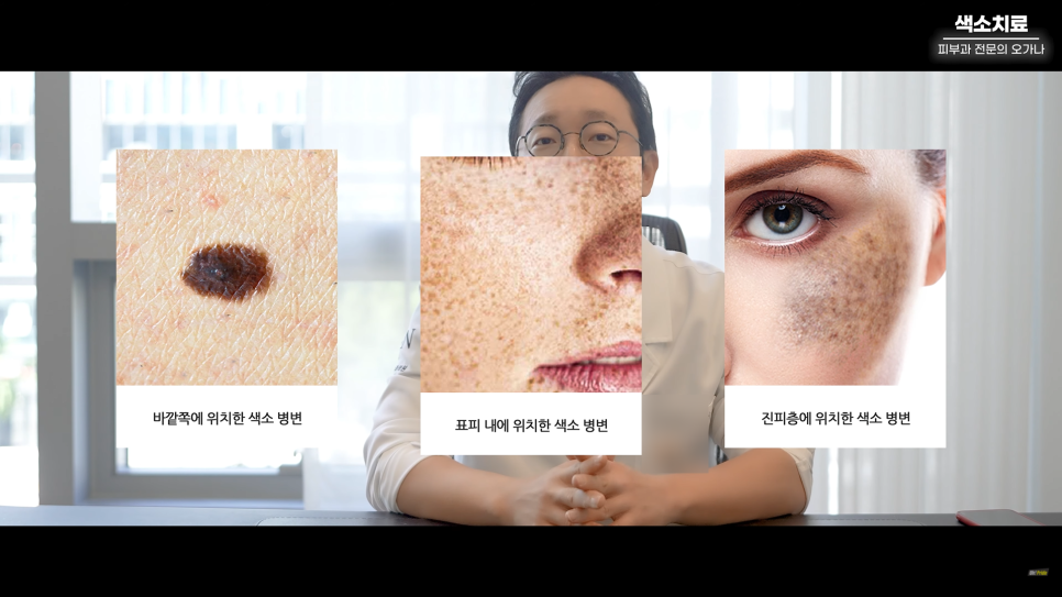 피부과 치료도 과유불급! 색소치료의 모든 것 #기미#색소병변#오타모반 | 오프라이드 오가나 관련 이미지 4