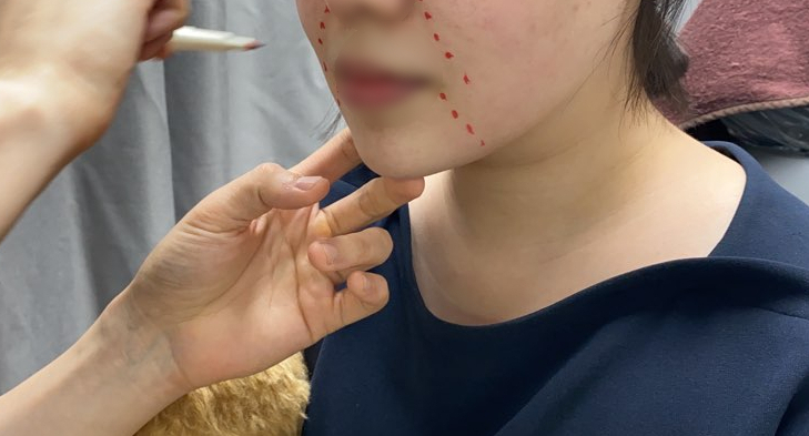 실리프팅 효과, 비용, 부작용 | 피부과전문의 오가나 관련 이미지 1