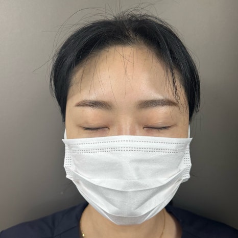이마 필러 꼭 2가지는 체크해 보시길 당부드립니다. 관련 이미지 2