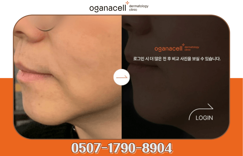 압구정 온다리프팅 잘하는곳 가격은 관련 이미지 15