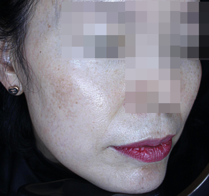 얼굴 실리프팅, 이런 분이 받으셔야 해요 관련 이미지 6