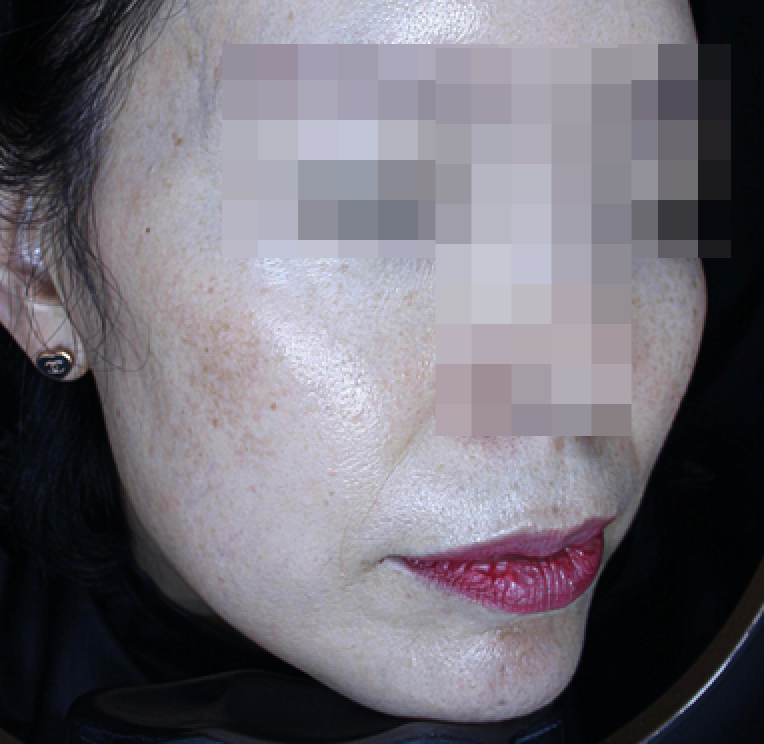 얼굴 실리프팅, 이런 분이 받으셔야 해요 관련 이미지 2