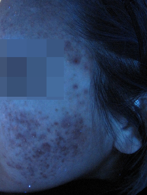 여드름 흉터, 염증 치료 가격만 비교해선 안되는 이유 관련 이미지 9