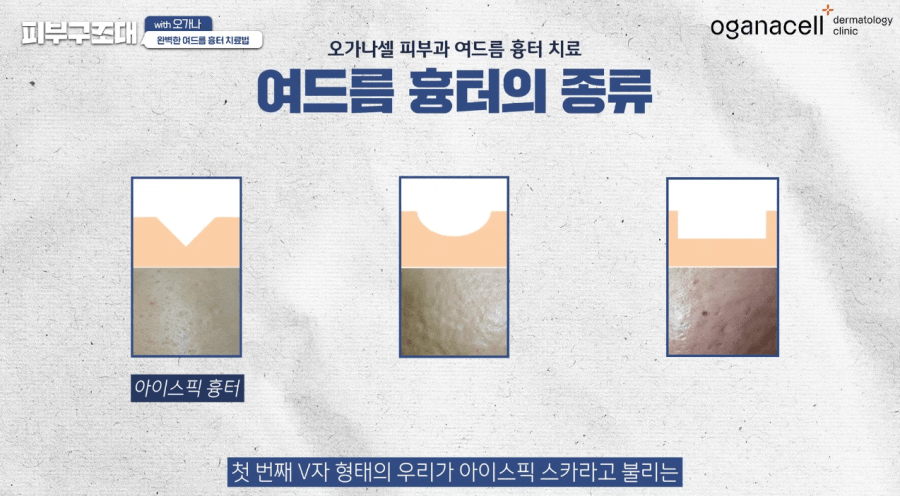 여드름 패인흉터 치료 방법 제대로알자 관련 이미지 9