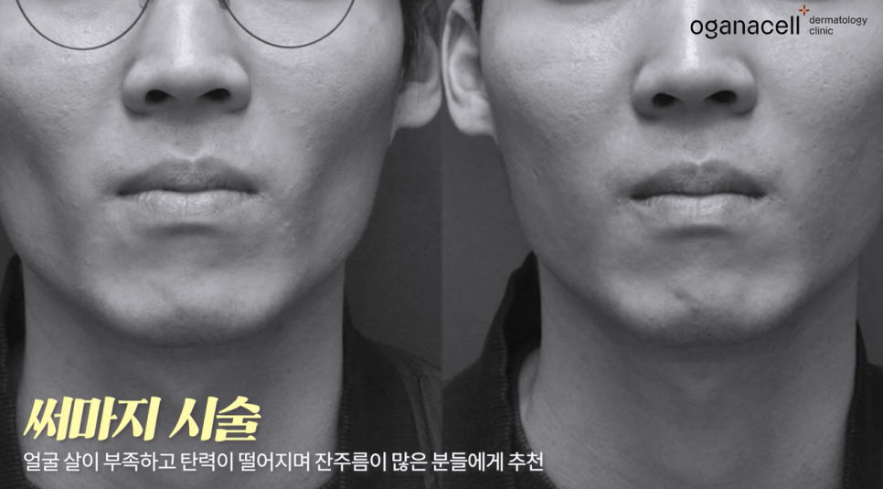 울쎄라 vs 써마지, 내 피부타입에 딱 맞는 리프팅 시술은? 관련 이미지 15