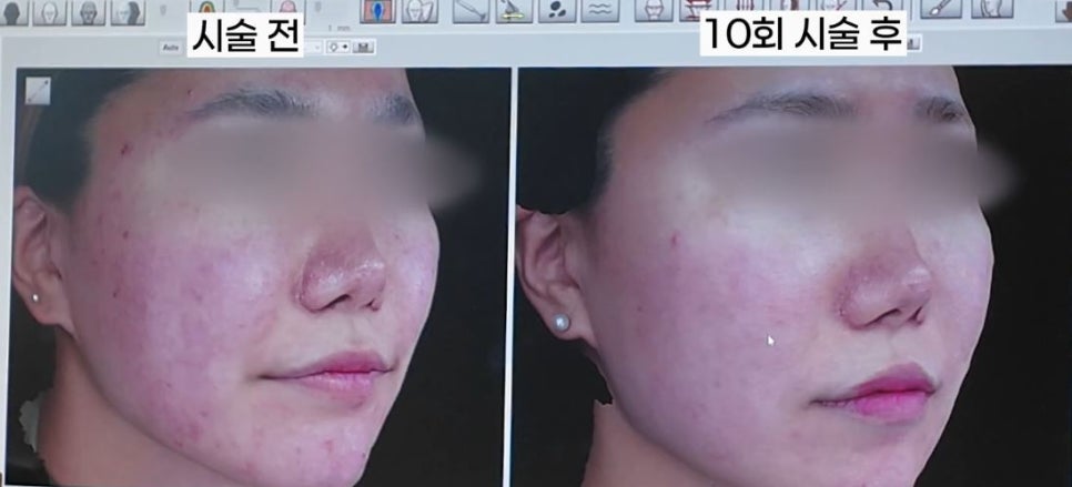 Real Acne Skin Correction Review (Feat. Before/After Photos of Acne in Your 30s) image 9