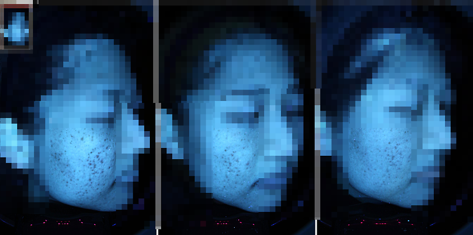 여드름 흉터 피부과, 롤링성 패인 흉터, 관련 자주 묻는 질문에 답해드립니다! 관련 이미지 3
