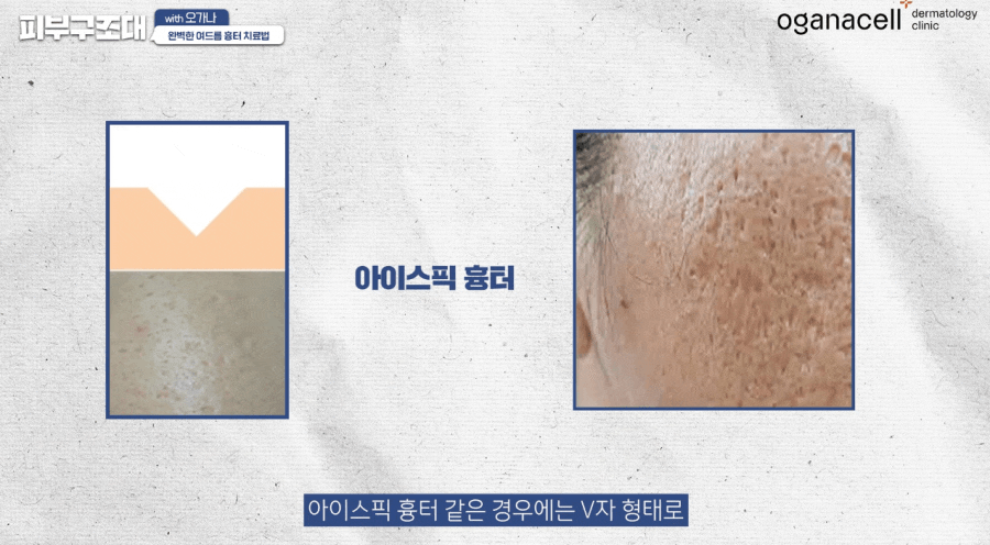 여드름 패인흉터 치료 방법 제대로알자 관련 이미지 13
