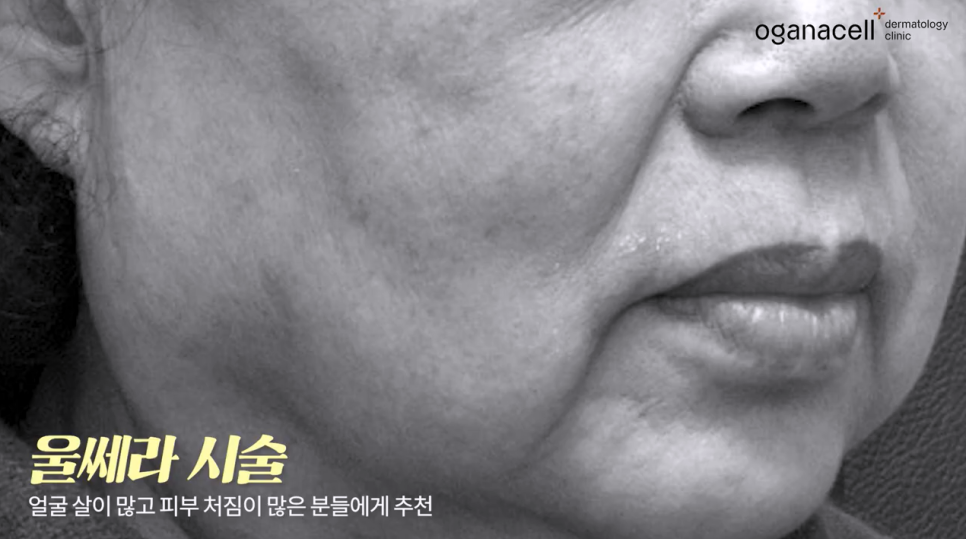 울쎄라 vs 써마지, 내 피부타입에 딱 맞는 리프팅 시술은? 관련 이미지 13