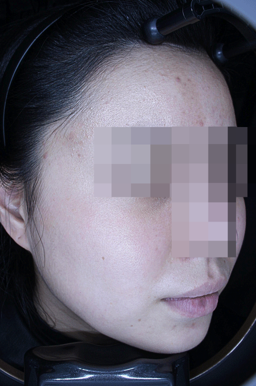 온다 리프팅, 통증에 민감한 분들을 위한 선택지 관련 이미지 2