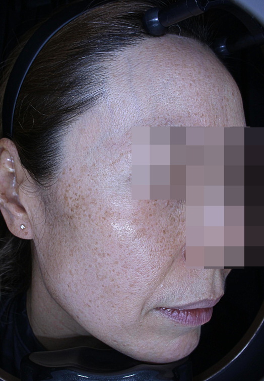 얼굴 색소침착 치료 가격만 보고 선택하면 후회합니다 관련 이미지 2