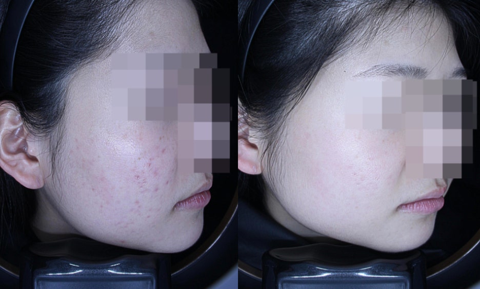16년 전문의가 소개하는 여드름 흉터 레이저 시술 치료 사례 관련 이미지 10