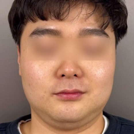 온다리프팅 심부볼제거 통증없이 가능합니다 관련 이미지 9