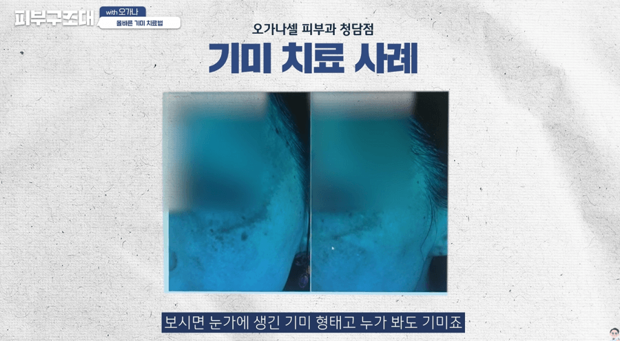 피코슈어레이저 기미 해결 가능할까? 관련 이미지 14