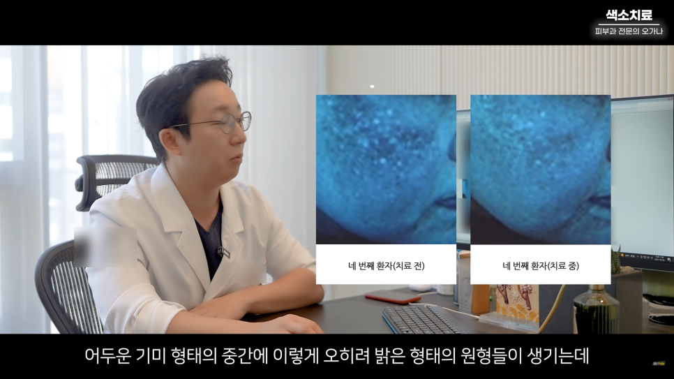 피부과 치료도 과유불급! 색소치료의 모든 것 #기미#색소병변#오타모반 | 오프라이드 오가나 관련 이미지 22