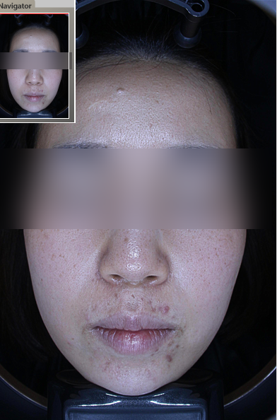 입 주변 여드름 원인, 피부 교정에 답이 있습니다. 관련 이미지 12