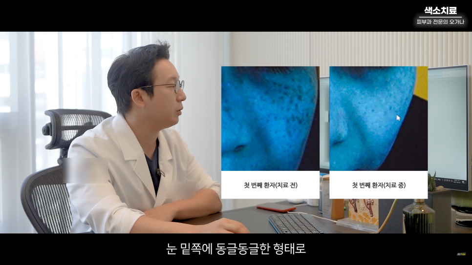 피부과 치료도 과유불급! 색소치료의 모든 것 #기미#색소병변#오타모반 | 오프라이드 오가나 관련 이미지 14