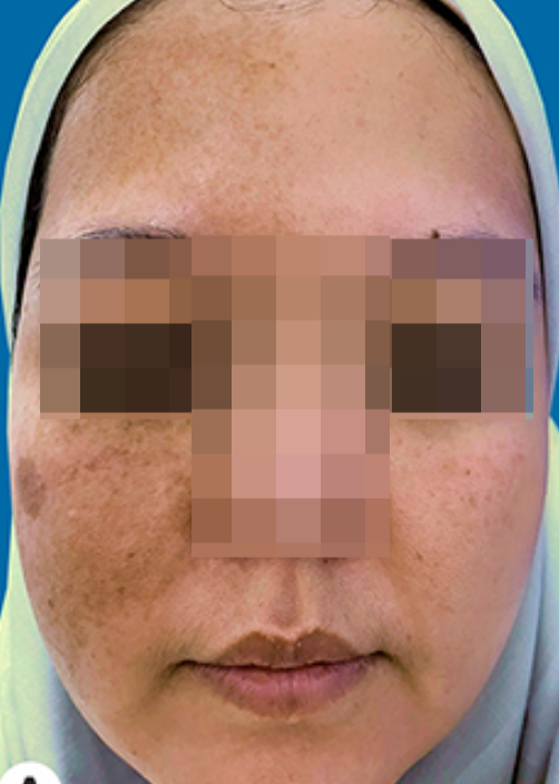 삼성역 인근 피부과 기미, 오타모반? 둘 다 아닐 수 있어요 관련 이미지 2