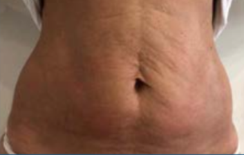 Be Sure to Check These Points for the Full Effects of Cheongdam ONDA Lifting! image 13