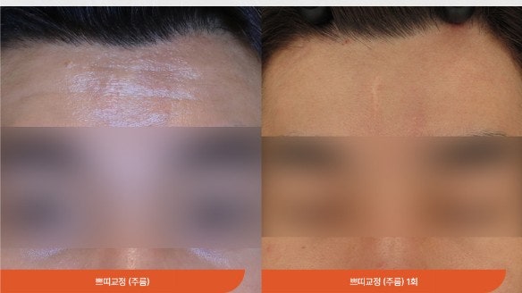 자갈턱보톡스 턱끝보톡스 알고하면 좋습니다 관련 이미지 11