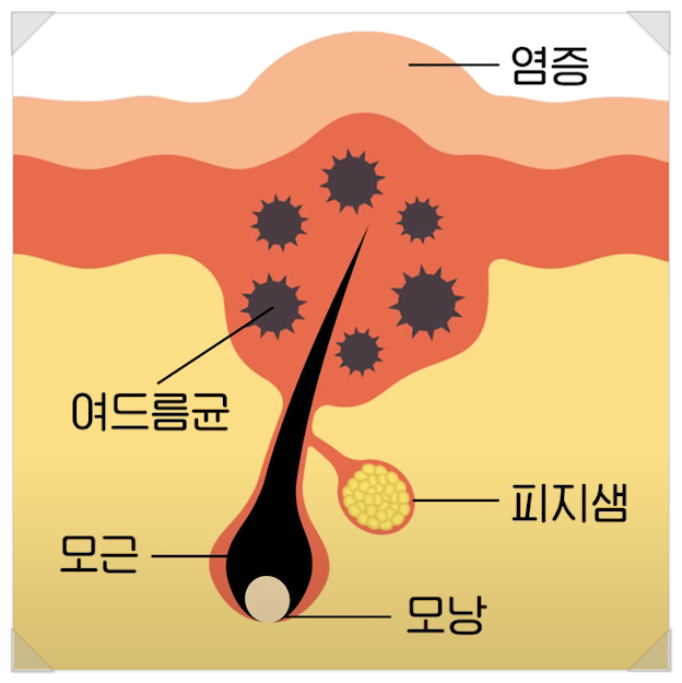 패인흉터 레이저, 과연 효과가 있을까? 전문의 소견 관련 이미지 4