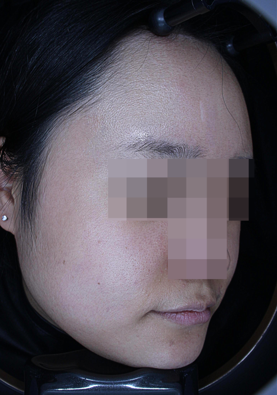 큐어젯 쥬베룩 흉터 치료 부작용에 대한 오해 - 전문의 작성 관련 이미지 2