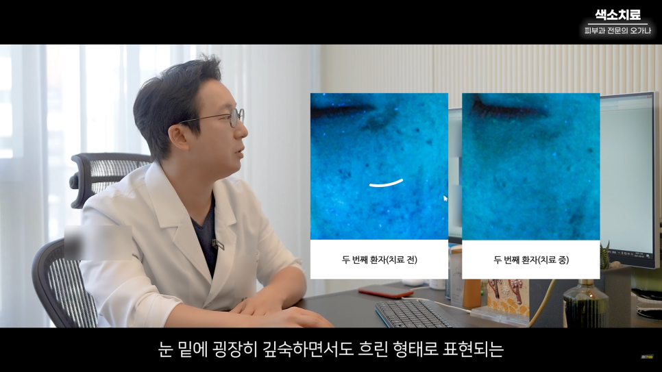 피부과 치료도 과유불급! 색소치료의 모든 것 #기미#색소병변#오타모반 | 오프라이드 오가나 관련 이미지 18