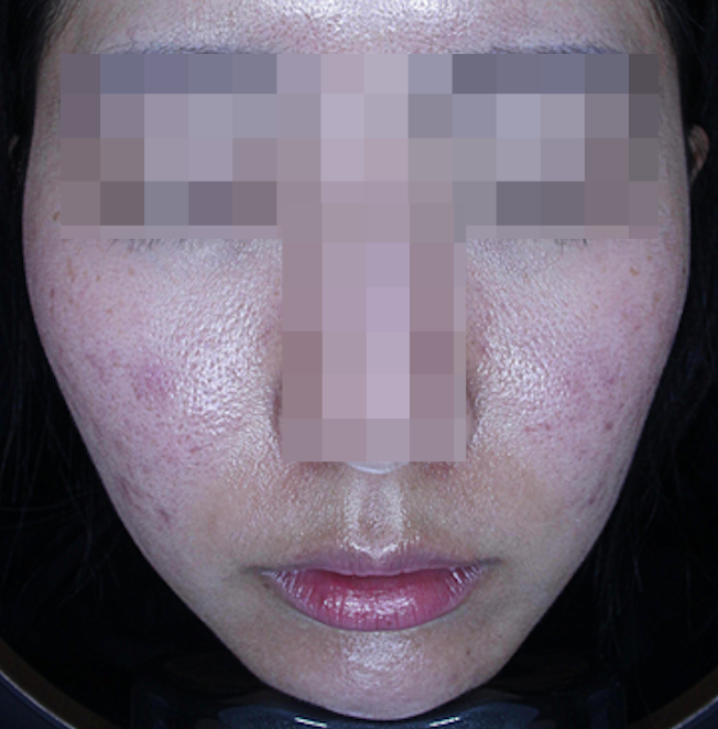 20대 여성 여드름 흉터 레이저 종류와 치료 사례 관련 이미지 6