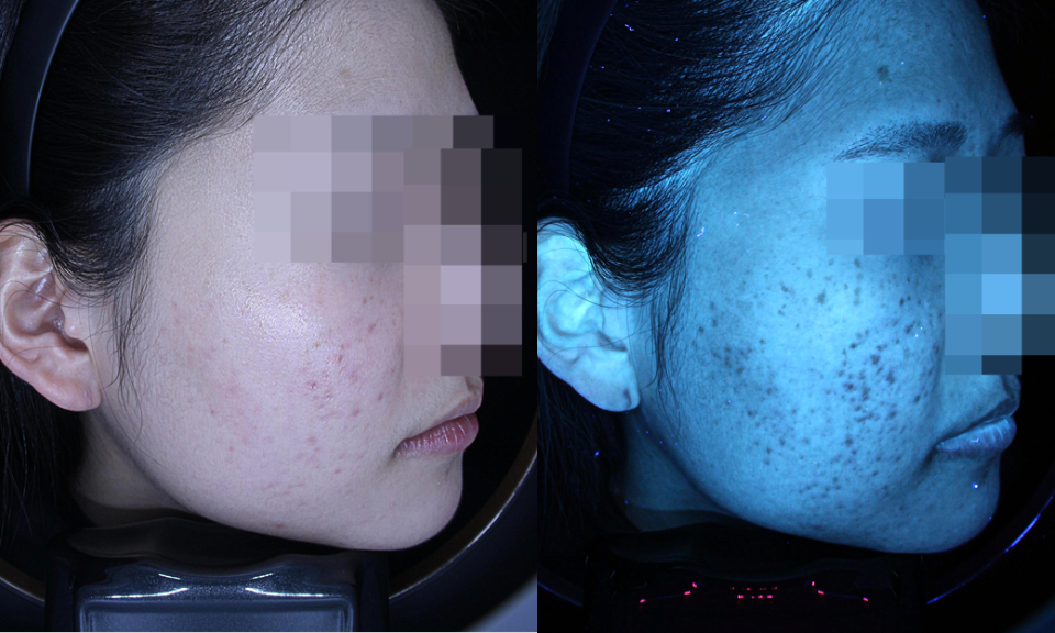 16년 전문의가 소개하는 여드름 흉터 레이저 시술 치료 사례 관련 이미지 2