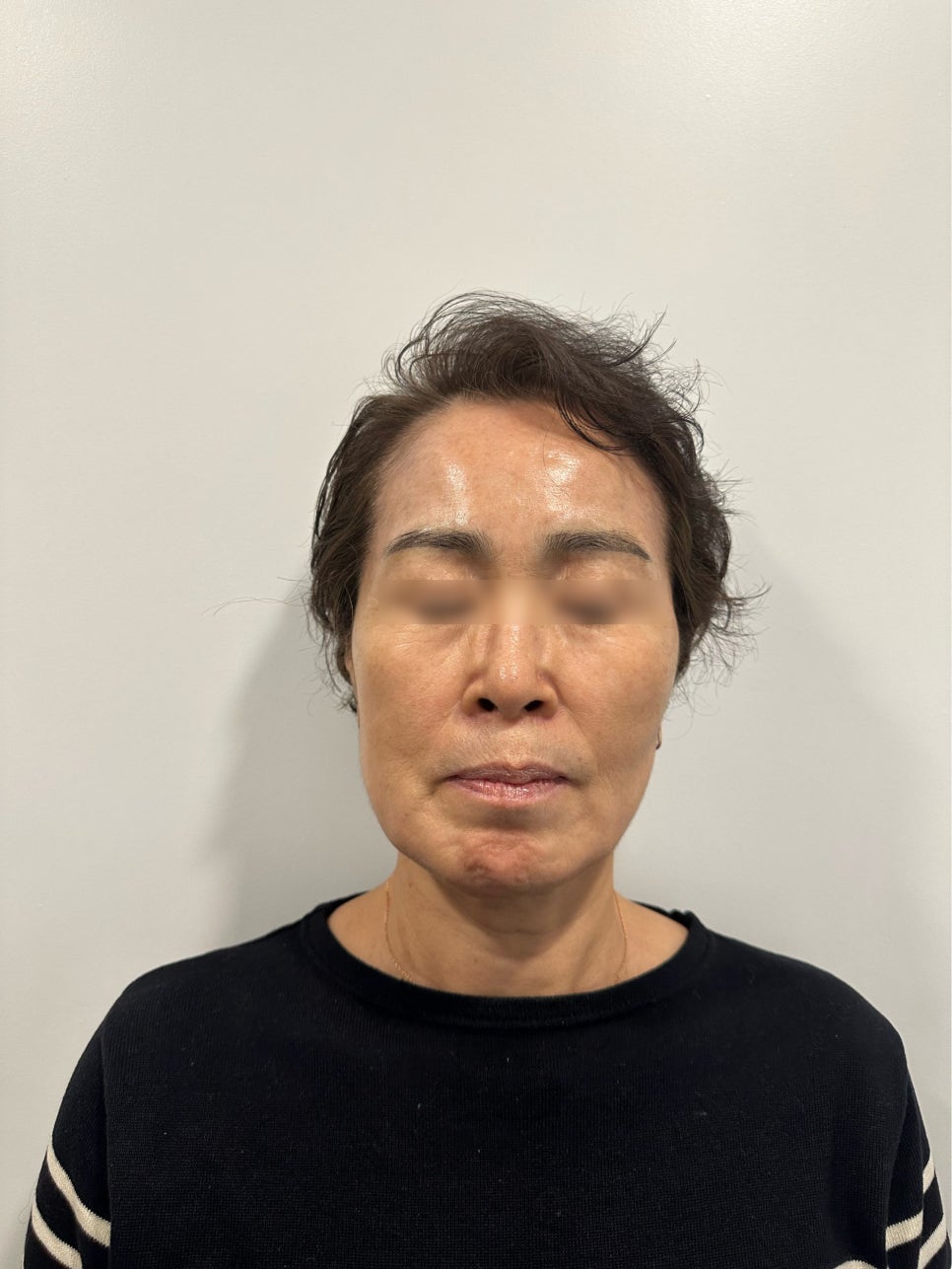 실리프팅 효과 300%보는 법 : 복합 리프팅 솔루션 관련 이미지 1