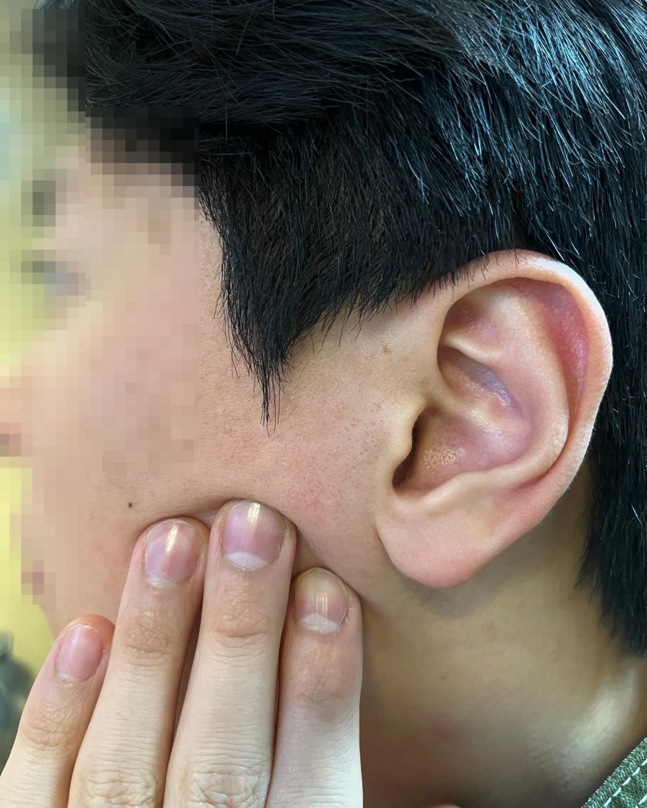 얼굴 실리프팅, 이런 분이 받으셔야 해요 관련 이미지 9
