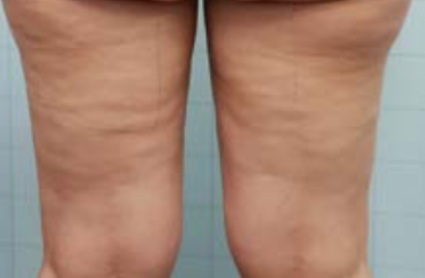 온다 리프팅, 통증에 민감한 분들을 위한 선택지 관련 이미지 8